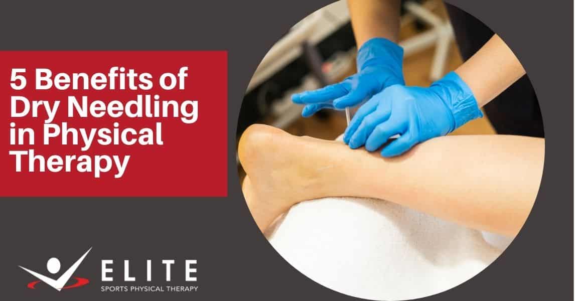 5 Benefits of Dry Needling in Physical Therapy